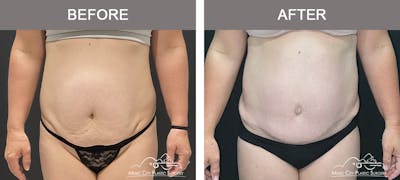 Tummy Tuck (Abdominoplasty) Before & After Gallery - Patient 380735 - Image 1