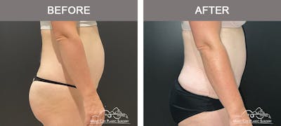 Liposuction Before & After Gallery - Patient 189126 - Image 2