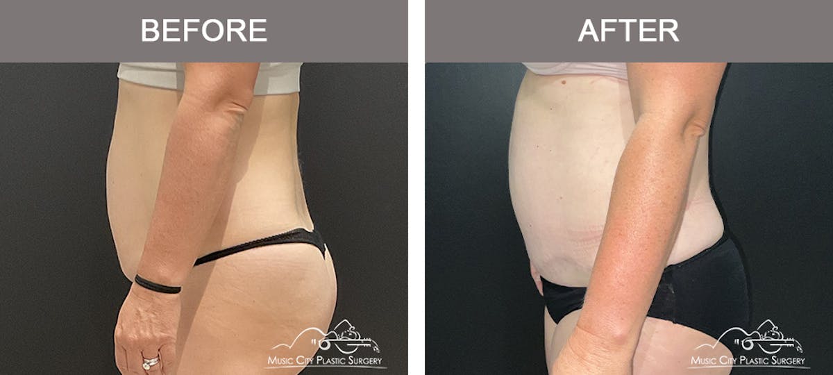 Liposuction Before & After Gallery - Patient 189126 - Image 3
