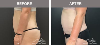 Liposuction Before & After Gallery - Patient 189126 - Image 3