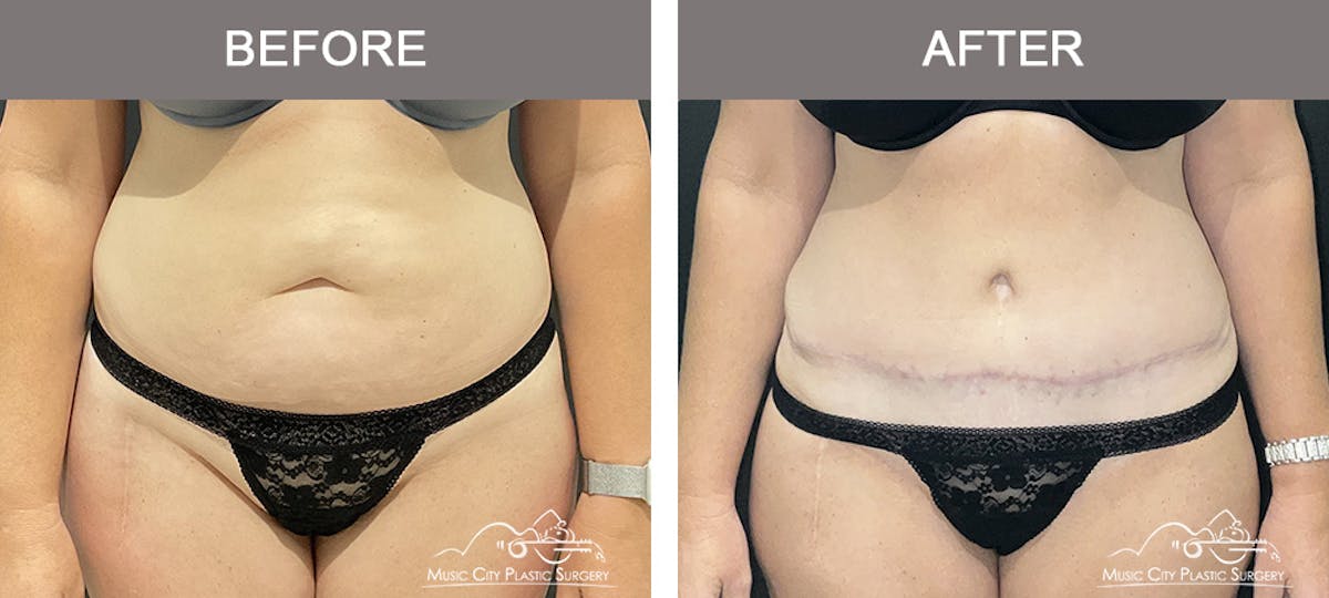 Liposuction Before & After Gallery - Patient 106949 - Image 1
