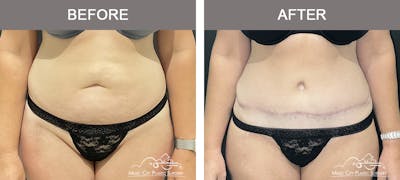 Tummy Tuck (Abdominoplasty) Before & After Gallery - Patient 273177 - Image 1