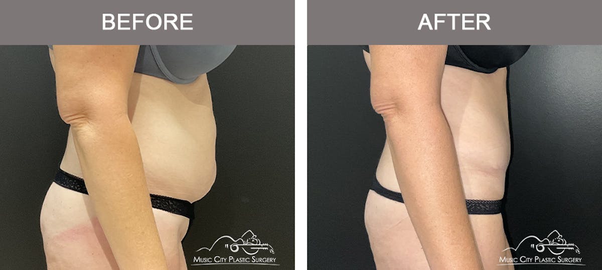 Liposuction Before & After Gallery - Patient 106949 - Image 2