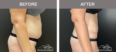 Liposuction Before & After Gallery - Patient 106949 - Image 2
