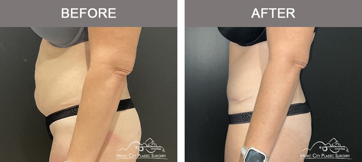 Liposuction Before & After Gallery - Patient 106949 - Image 3