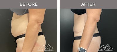 Liposuction Before & After Gallery - Patient 106949 - Image 3
