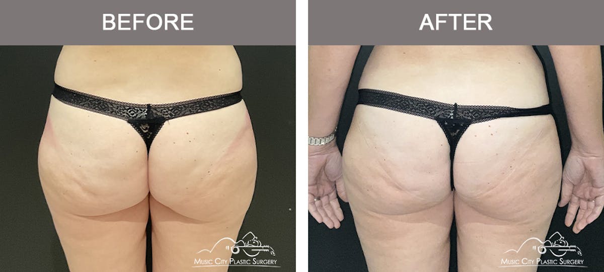Liposuction Before & After Gallery - Patient 106949 - Image 4