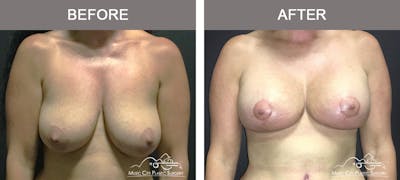 Breast Lift Before & After Gallery - Patient 135965 - Image 1