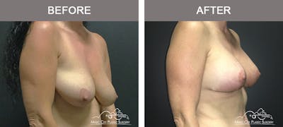 Breast Lift Before & After Gallery - Patient 135965 - Image 2