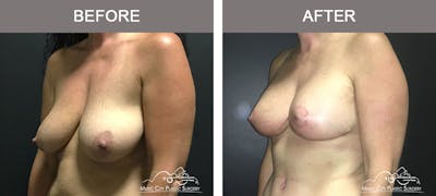 Breast Lift Before & After Gallery - Patient 135965 - Image 3