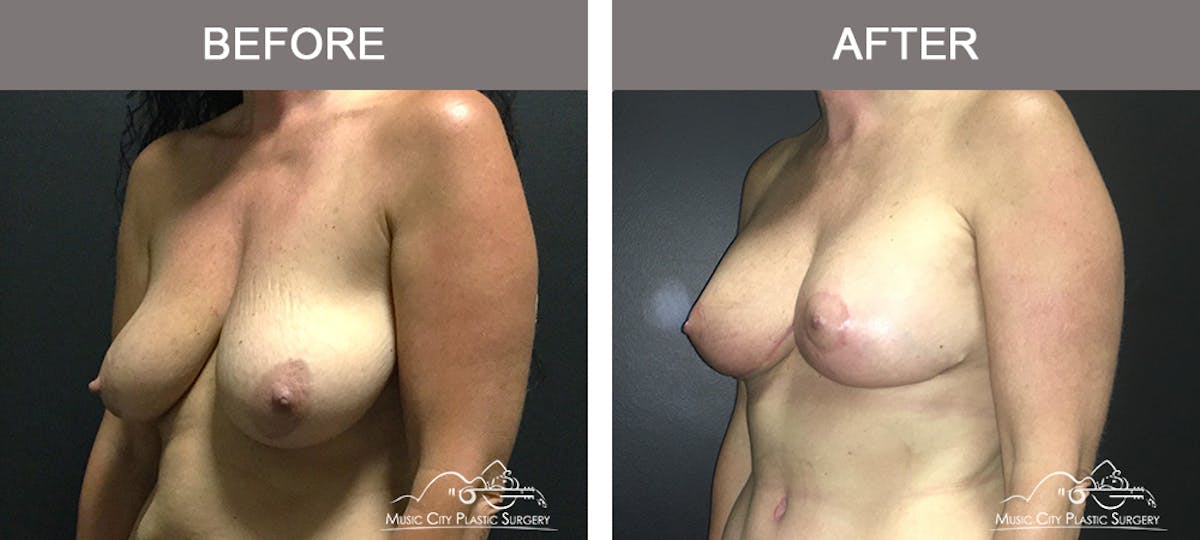 Breast Lift Before & After Gallery - Patient 135965 - Image 3
