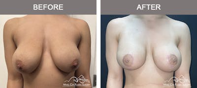 Breast Lift Before & After Gallery - Patient 196294447 - Image 1