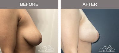 Breast Lift with Augmentation Before & After Gallery - Patient 483884 - Image 2