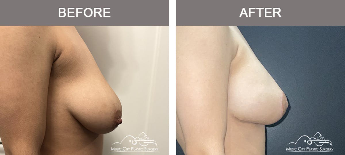 Breast Lift Before & After Gallery - Patient 196294447 - Image 2
