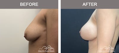 Breast Lift with Augmentation Before & After Gallery - Patient 483884 - Image 3