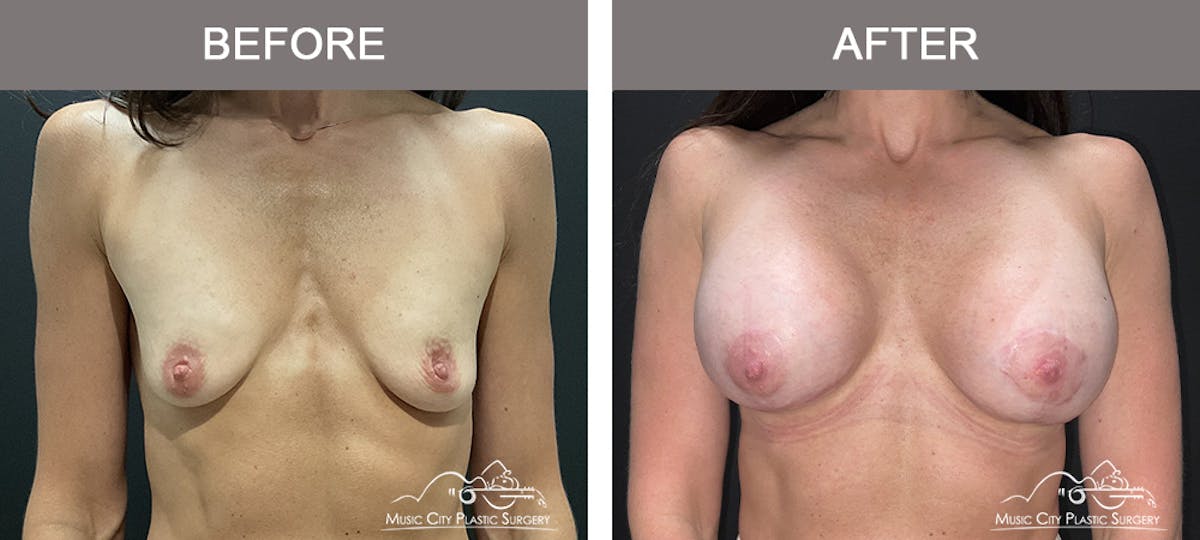 Breast Lift with Augmentation Before & After Gallery - Patient 153297 - Image 1