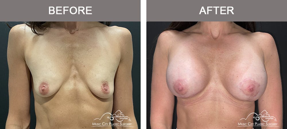 Breast Augmentation Before & After Gallery - Patient 376047 - Image 1