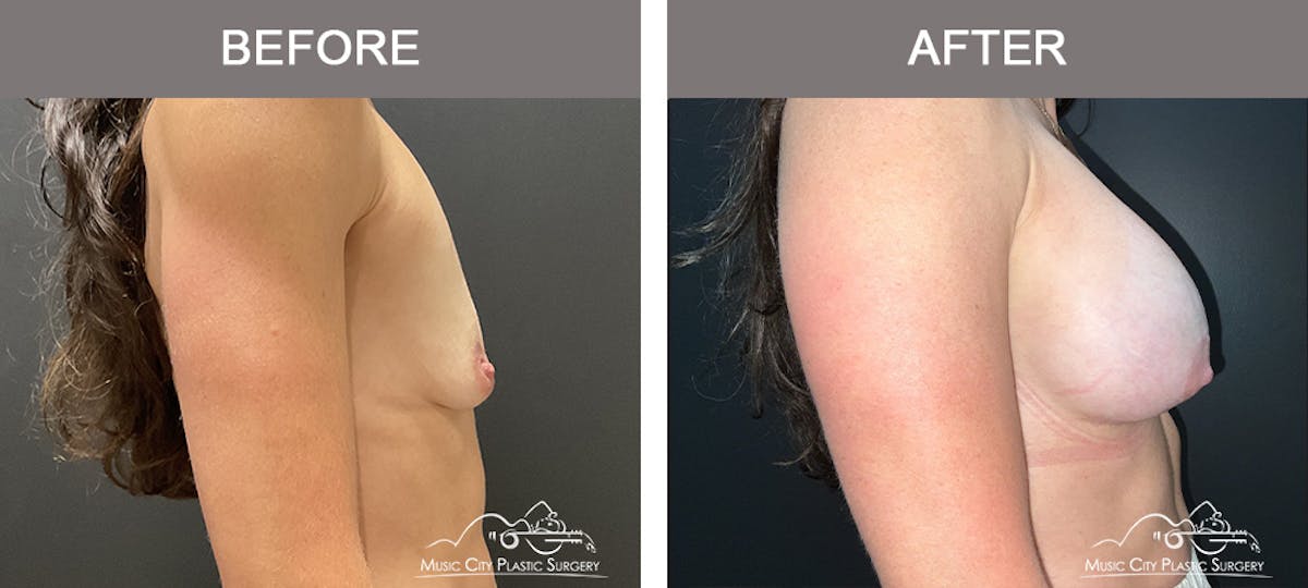 Breast Lift with Augmentation Before & After Gallery - Patient 153297 - Image 2