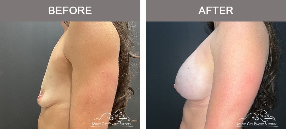 Breast Augmentation Before & After Gallery - Patient 376047 - Image 3