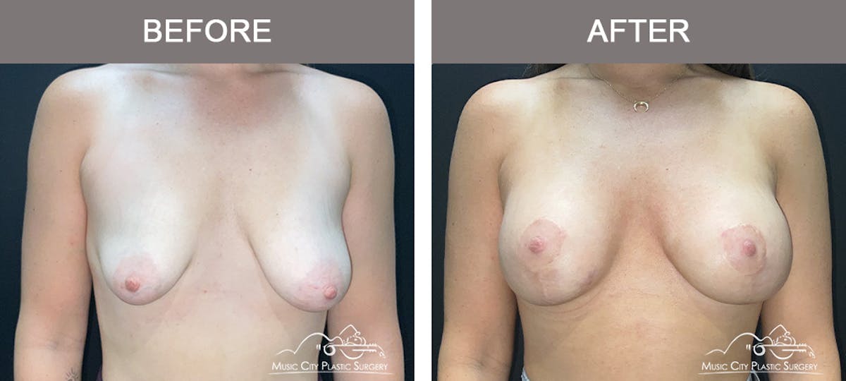 Breast Augmentation Before & After Gallery - Patient 310890 - Image 1