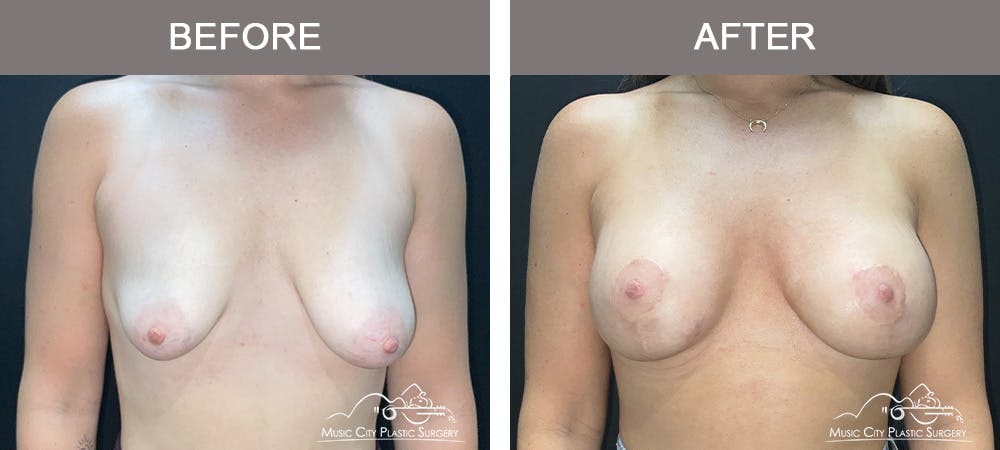 Breast Augmentation Before & After Gallery - Patient 310890 - Image 1