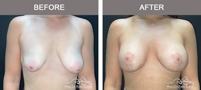 Breast Lift Before & After Gallery - Patient 342552 - Image 1