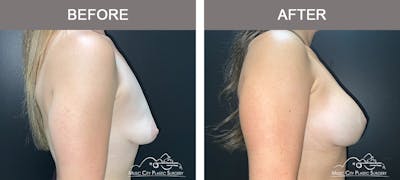Breast Lift with Augmentation Before & After Gallery - Patient 121338 - Image 2