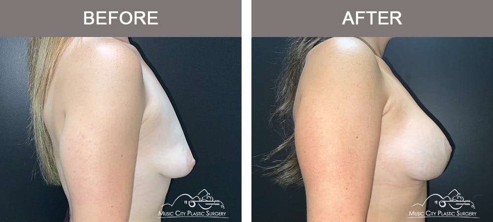 Breast Augmentation Before & After Gallery - Patient 310890 - Image 2