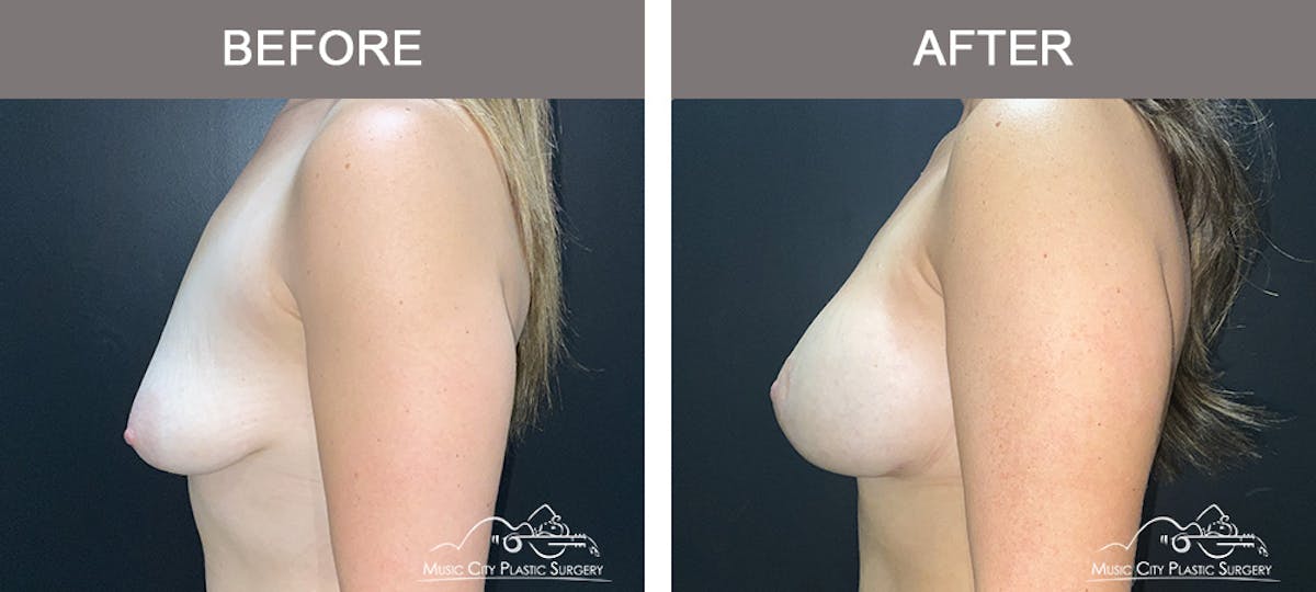 Breast Augmentation Before & After Gallery - Patient 310890 - Image 3
