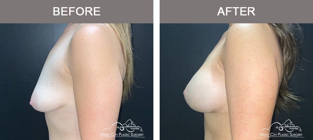 Breast Augmentation Before & After Gallery - Patient 310890 - Image 3