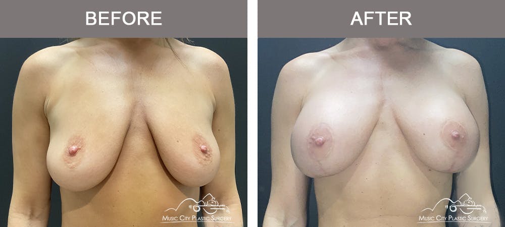 Breast Augmentation Before & After Gallery - Patient 216600 - Image 1