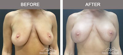 Breast Lift Before & After Gallery - Patient 105821 - Image 1