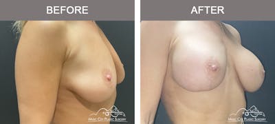 Breast Lift with Augmentation Before & After Gallery - Patient 226225 - Image 2