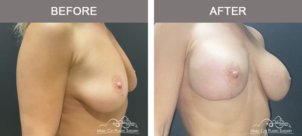 Breast Augmentation Before & After Gallery - Patient 216600 - Image 2