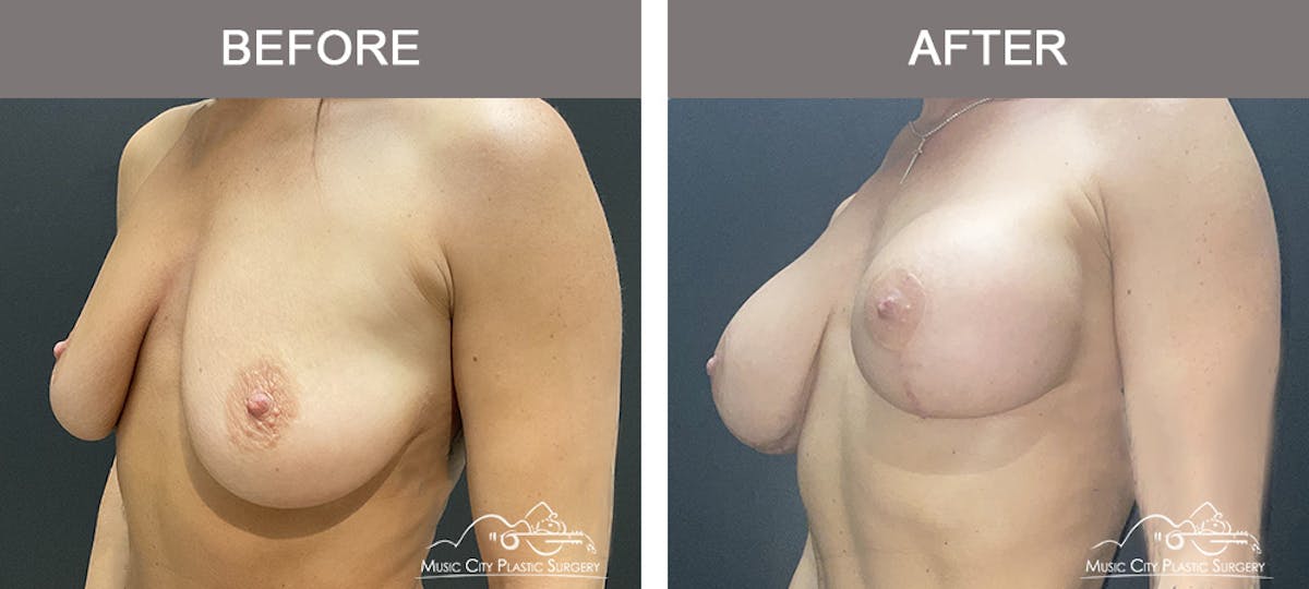 Breast Lift with Augmentation Before & After Gallery - Patient 226225 - Image 3