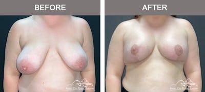 Breast Lift with Augmentation Before & After Gallery - Patient 360209 - Image 1