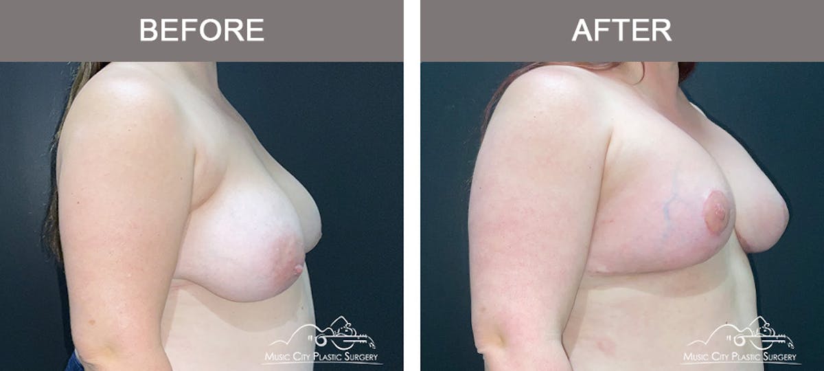 Breast Lift Before & After Gallery - Patient 256062 - Image 2