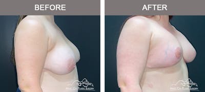 Breast Lift Before & After Gallery - Patient 256062 - Image 2
