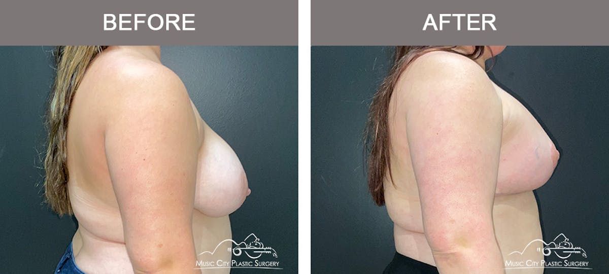 Breast Lift Before & After Gallery - Patient 256062 - Image 3