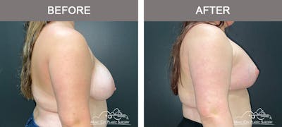 Breast Lift Before & After Gallery - Patient 256062 - Image 3