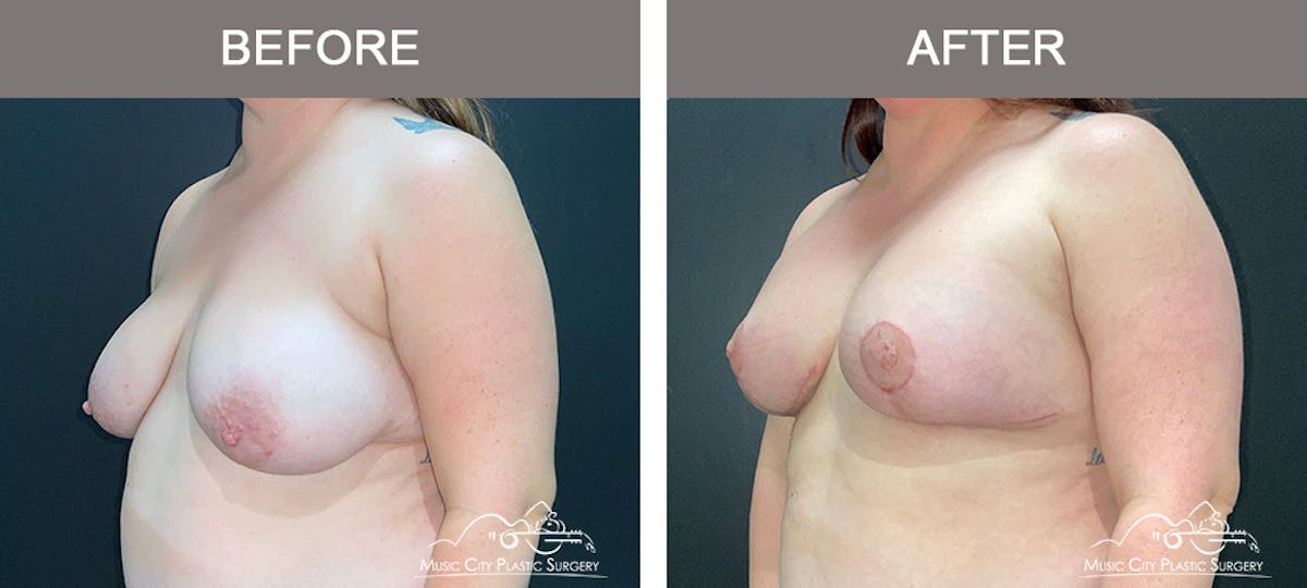 Breast Lift Before & After Gallery - Patient 256062 - Image 4
