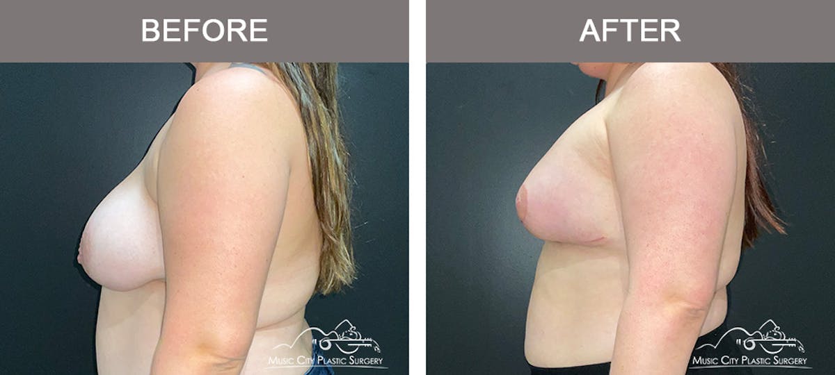 Breast Lift Before & After Gallery - Patient 256062 - Image 5