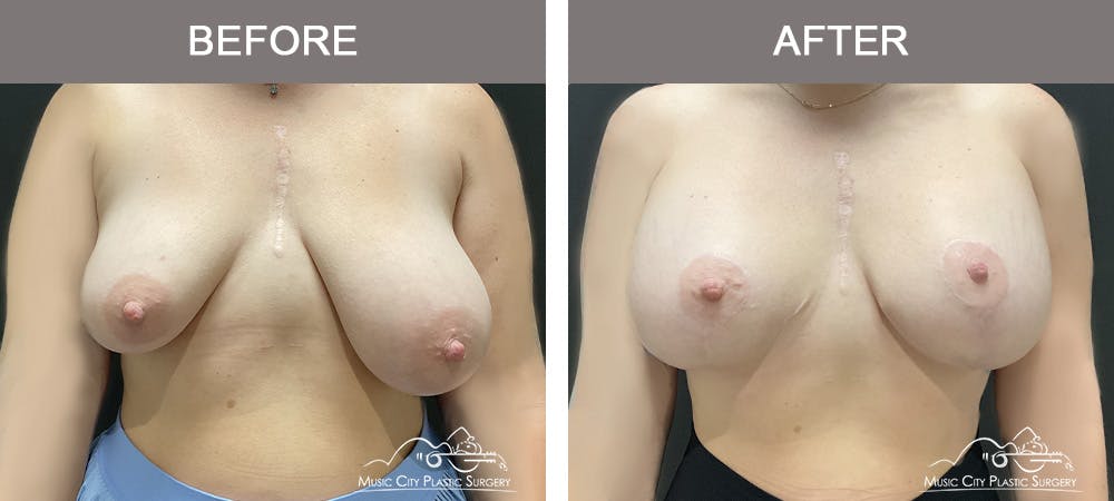 Breast Augmentation Before & After Gallery - Patient 355231 - Image 1