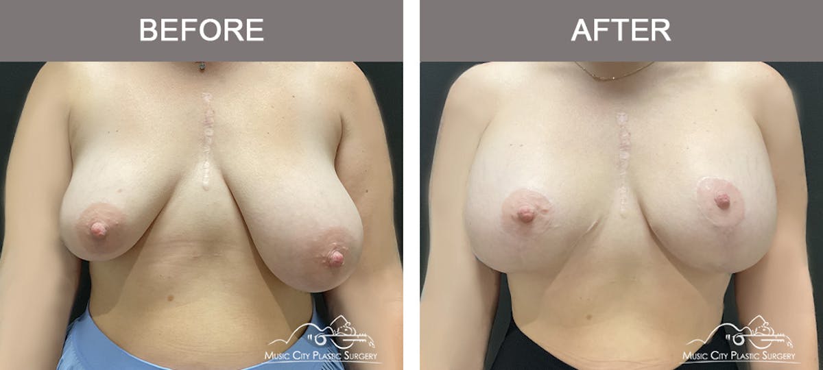 Breast Augmentation Before & After Gallery - Patient 355231 - Image 1