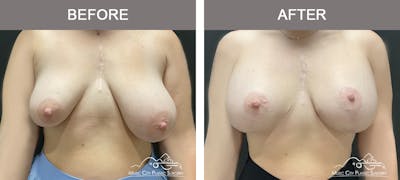 Breast Lift with Augmentation Before & After Gallery - Patient 272097 - Image 1