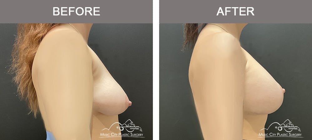 Breast Augmentation Before & After Gallery - Patient 355231 - Image 2