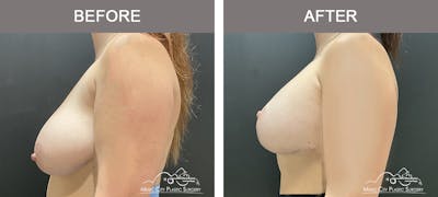 Breast Lift Before & After Gallery - Patient 397851 - Image 3