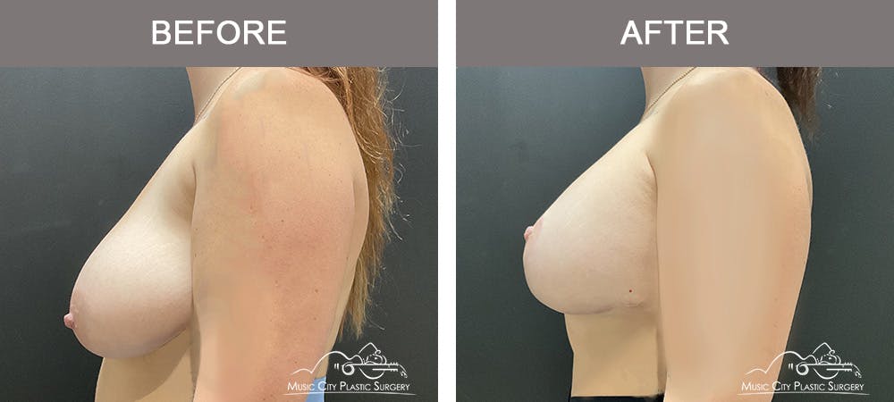 Breast Augmentation Before & After Gallery - Patient 355231 - Image 3