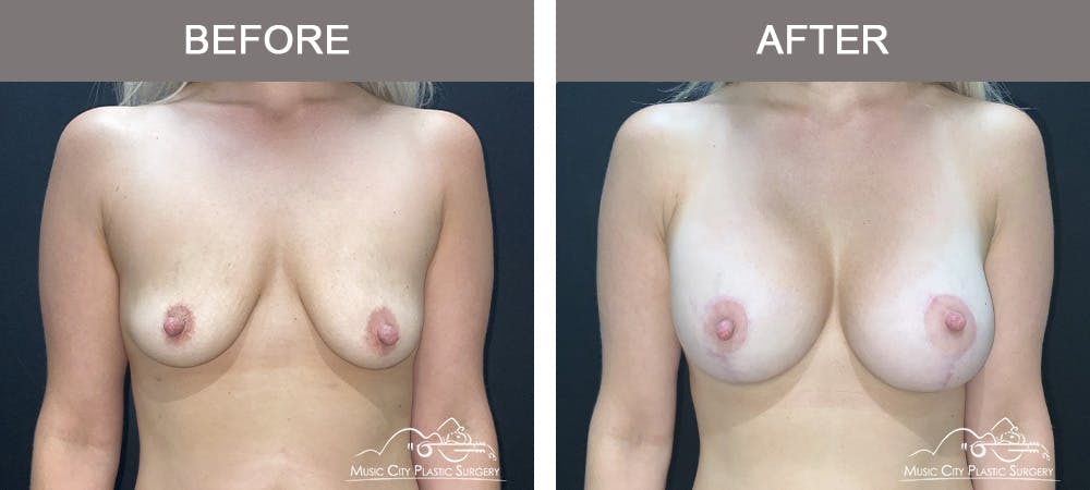 Breast Augmentation Before & After Gallery - Patient 290535 - Image 1