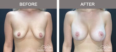 Breast Lift with Augmentation Before & After Gallery - Patient 698992 - Image 1